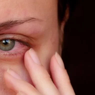 Ochi iritat cu umflături pe scleră: ce înseamnă și ce poți face